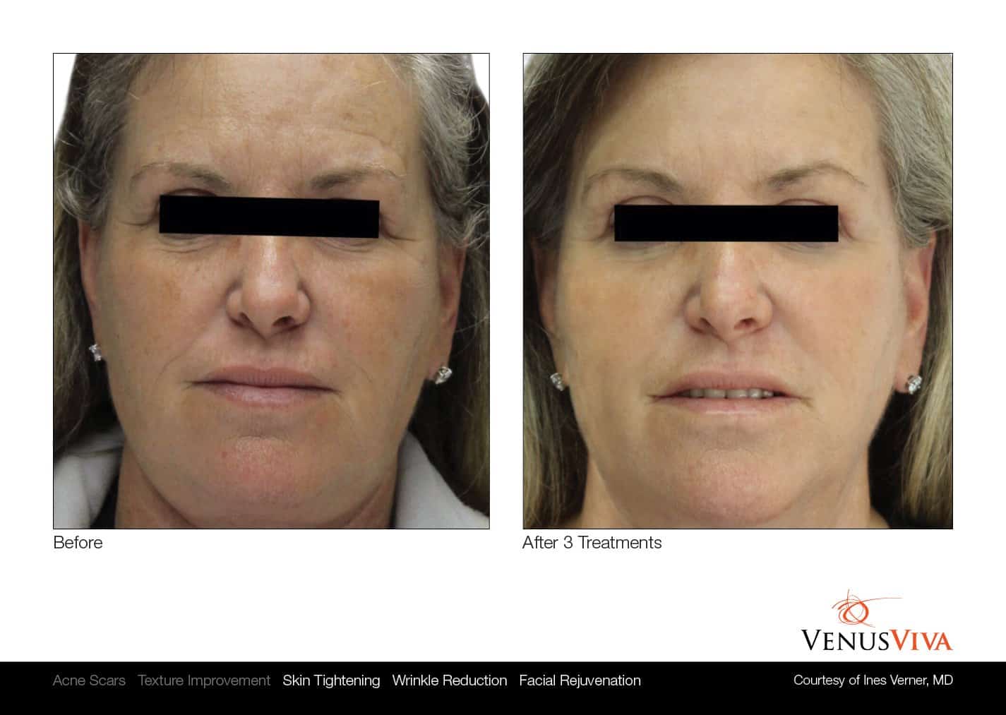 טיפולי פנים - - VENUS CONCEPT