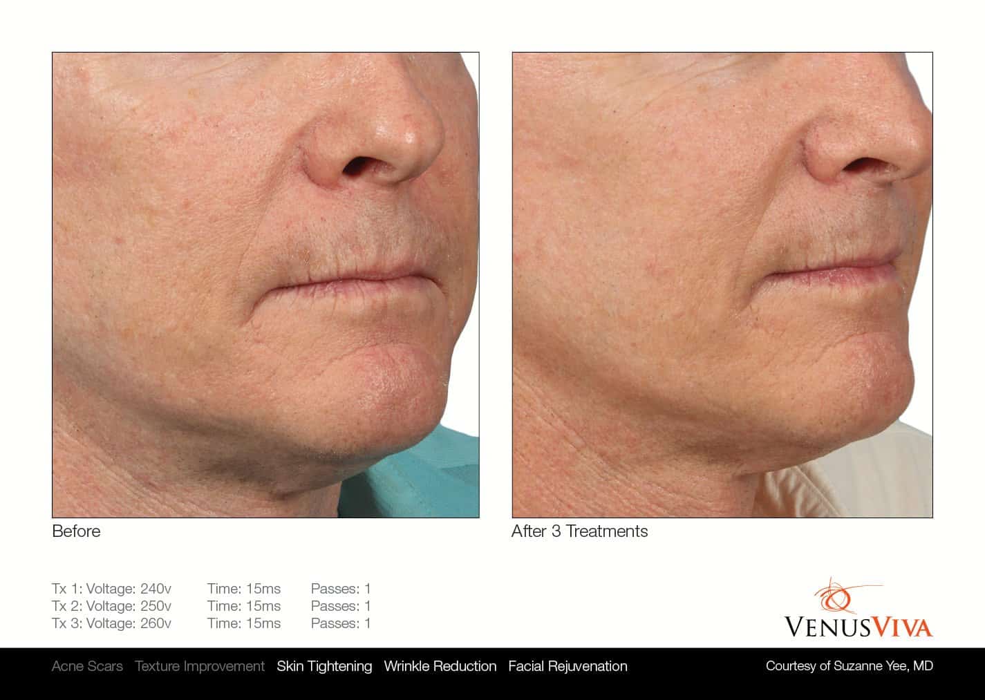 טיפולי פנים - VENUS CONCEPT