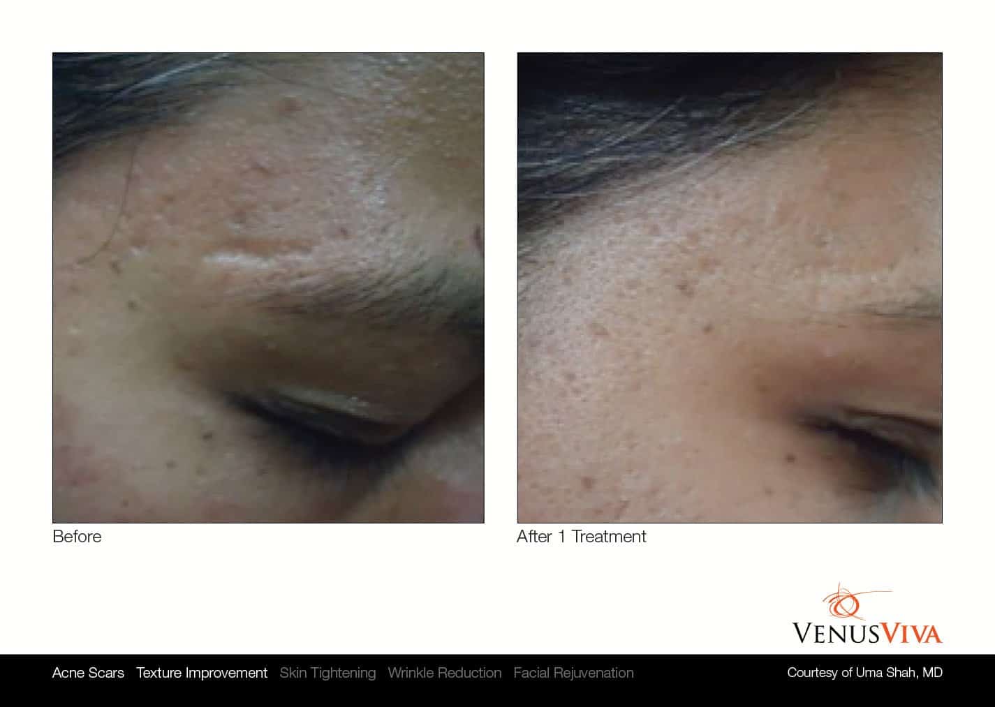 טיפולי פנים - VENUS CONCEPT
